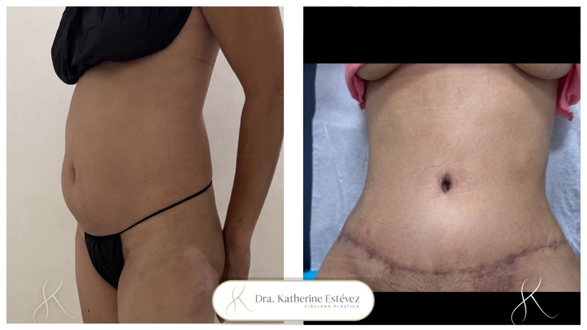 Abdominoplastia
