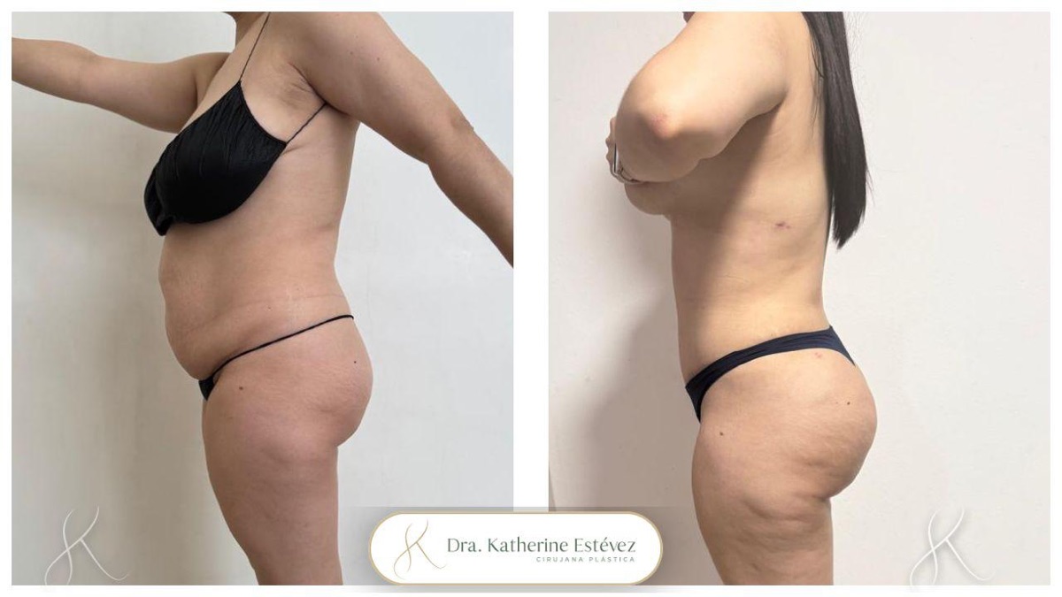 Abdominoplastia + Lipo