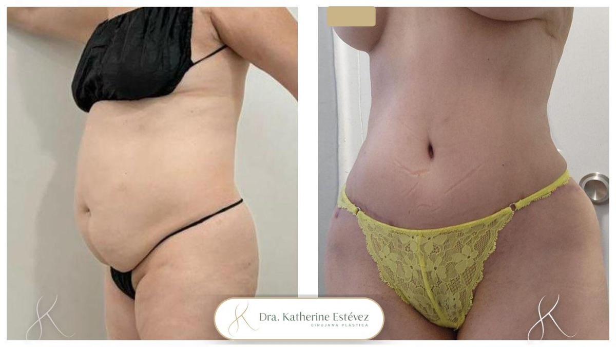 Abdominoplastia + Lipo