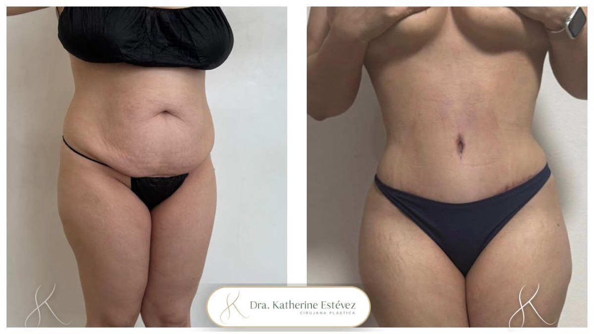 Abdominoplastia