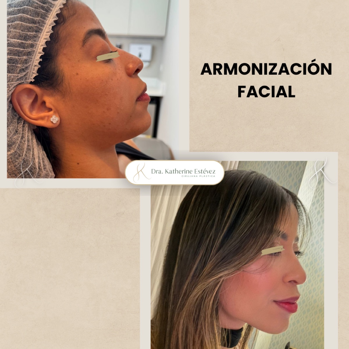 Armonización Facial
