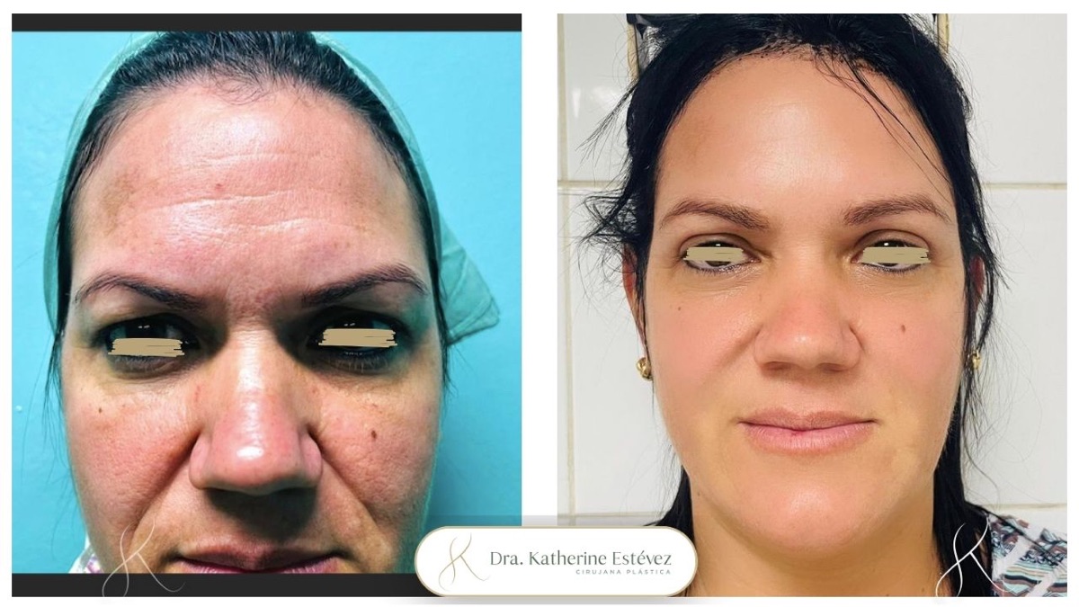 Resultado blefaroplastia