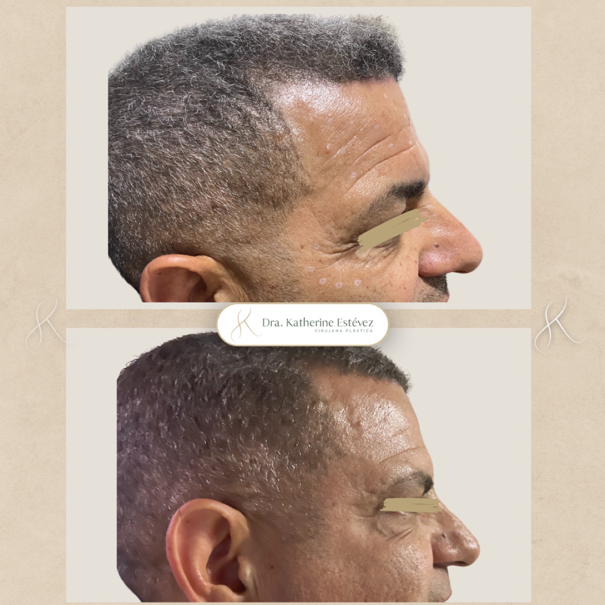 Botox