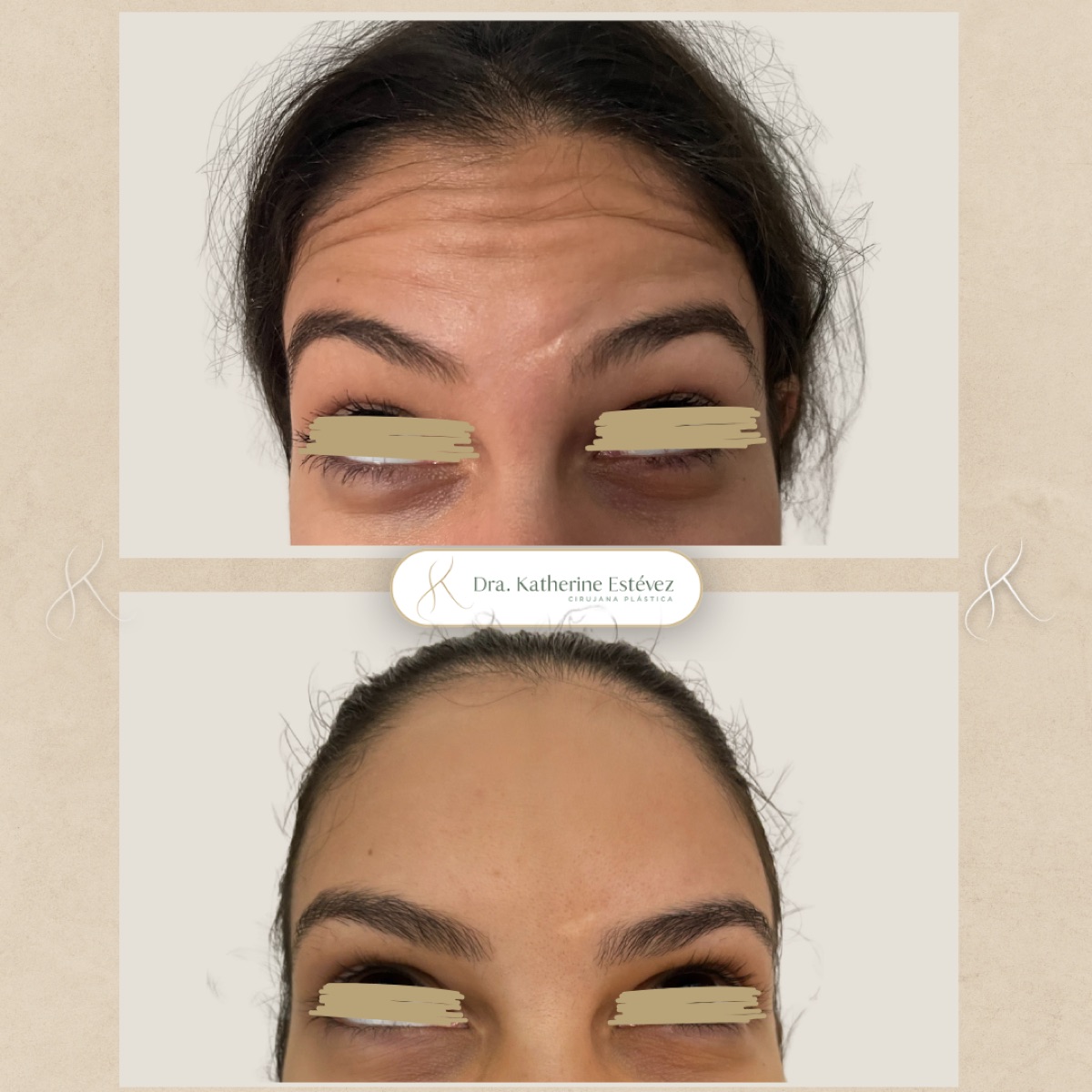 Botox