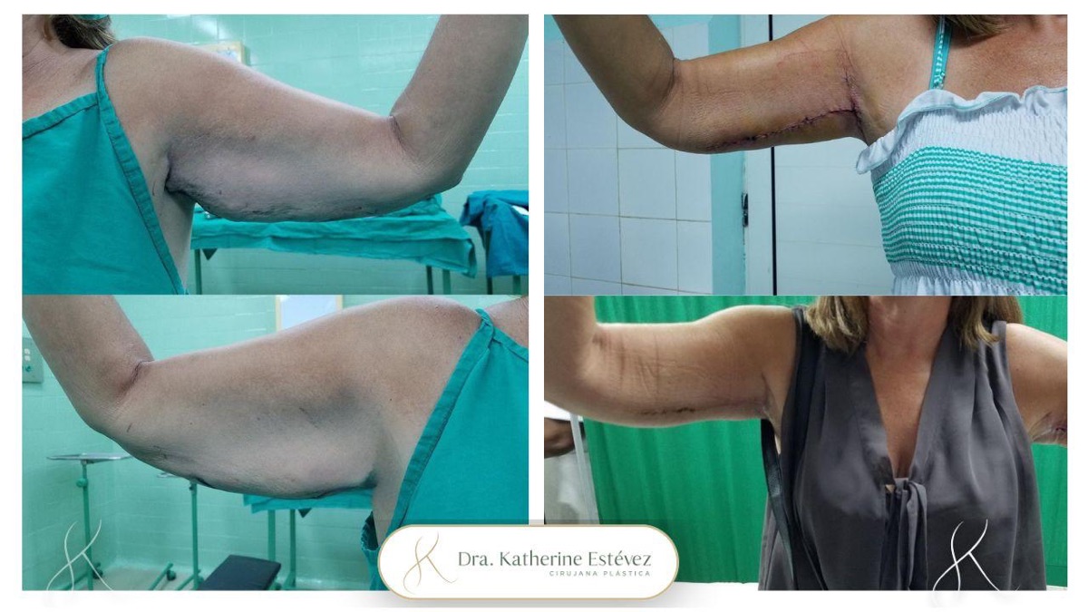 Braquioplastia