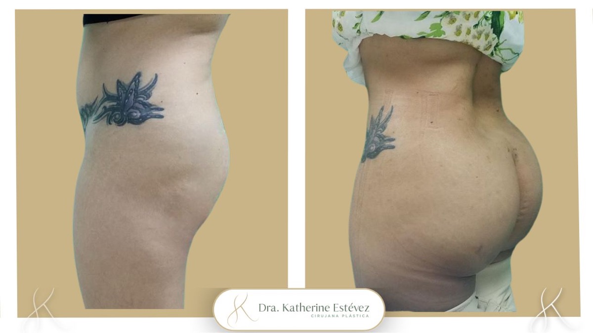 Gluteoplastia