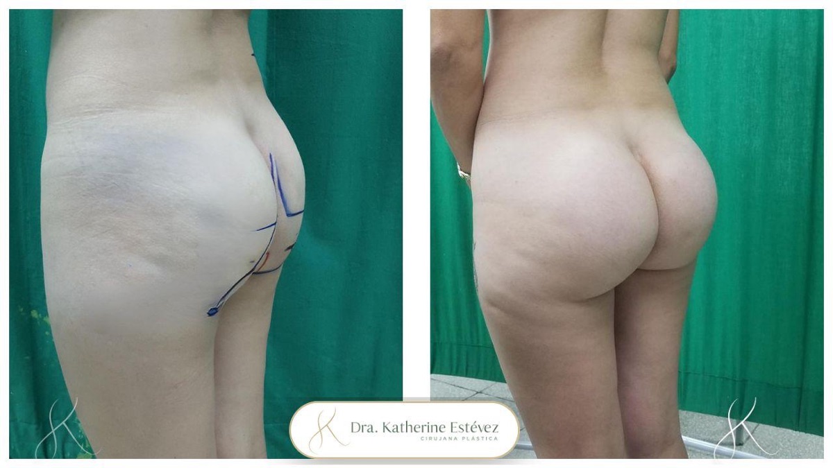 Gluteoplastia