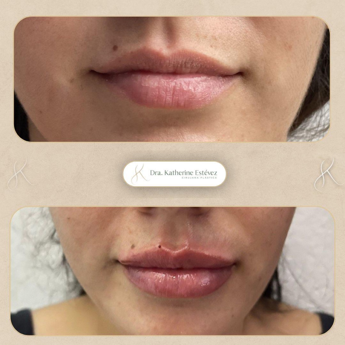 Aumento de Labios