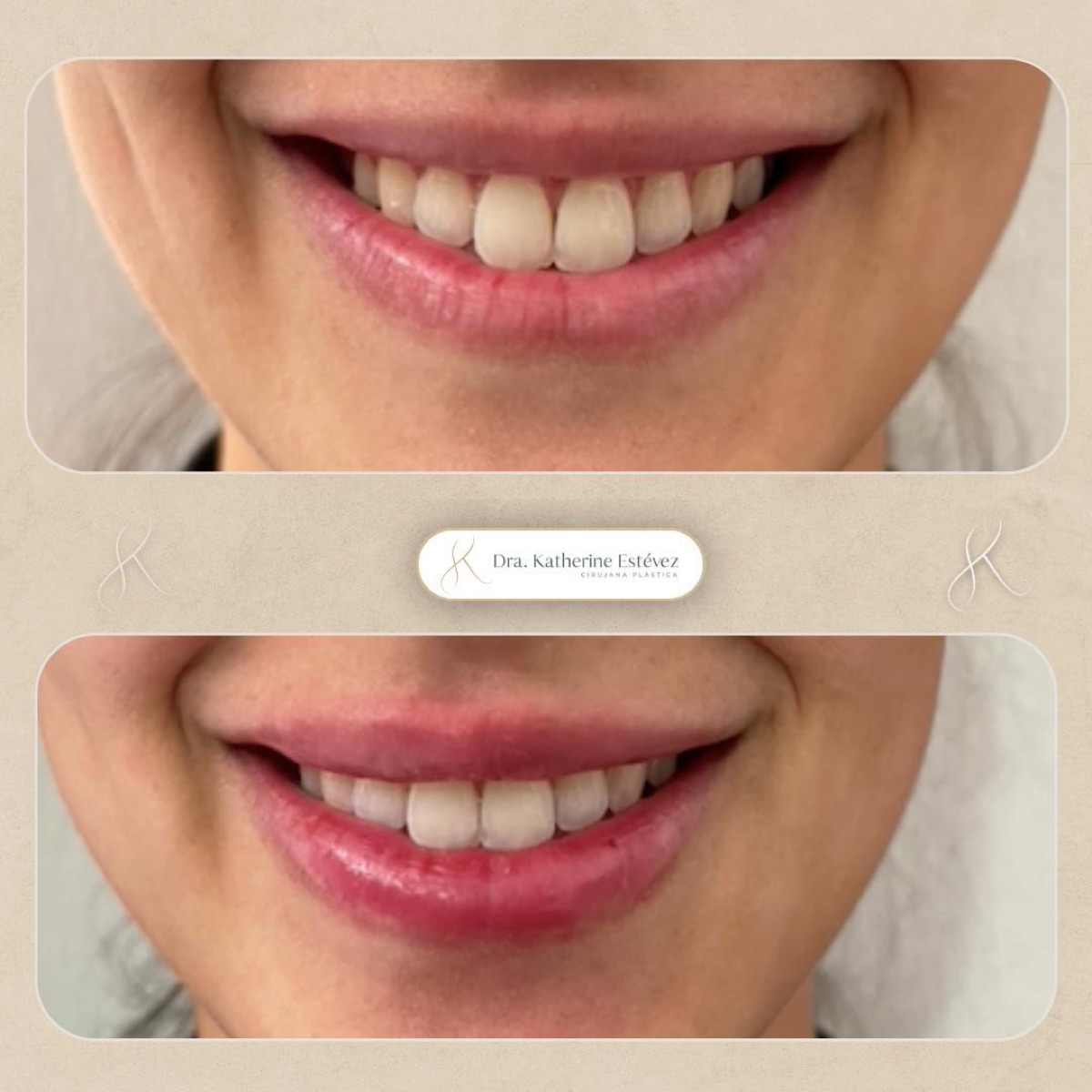 Aumento de Labios
