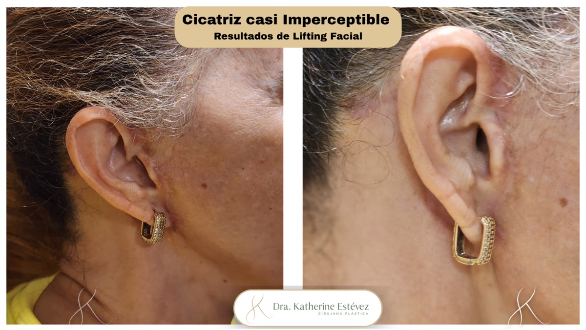Resultado lifting facial