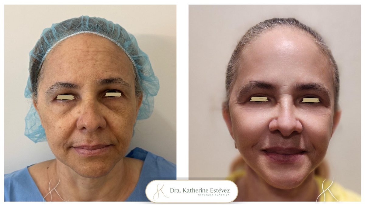 Lifting facial 2