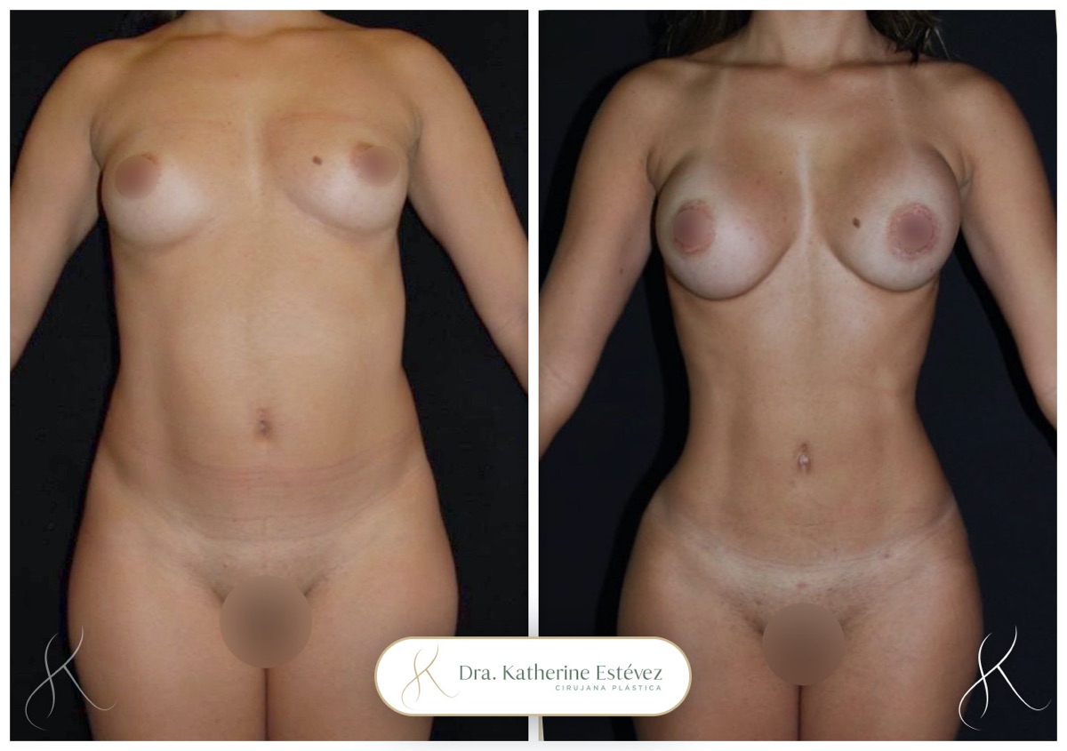 Lipo HD