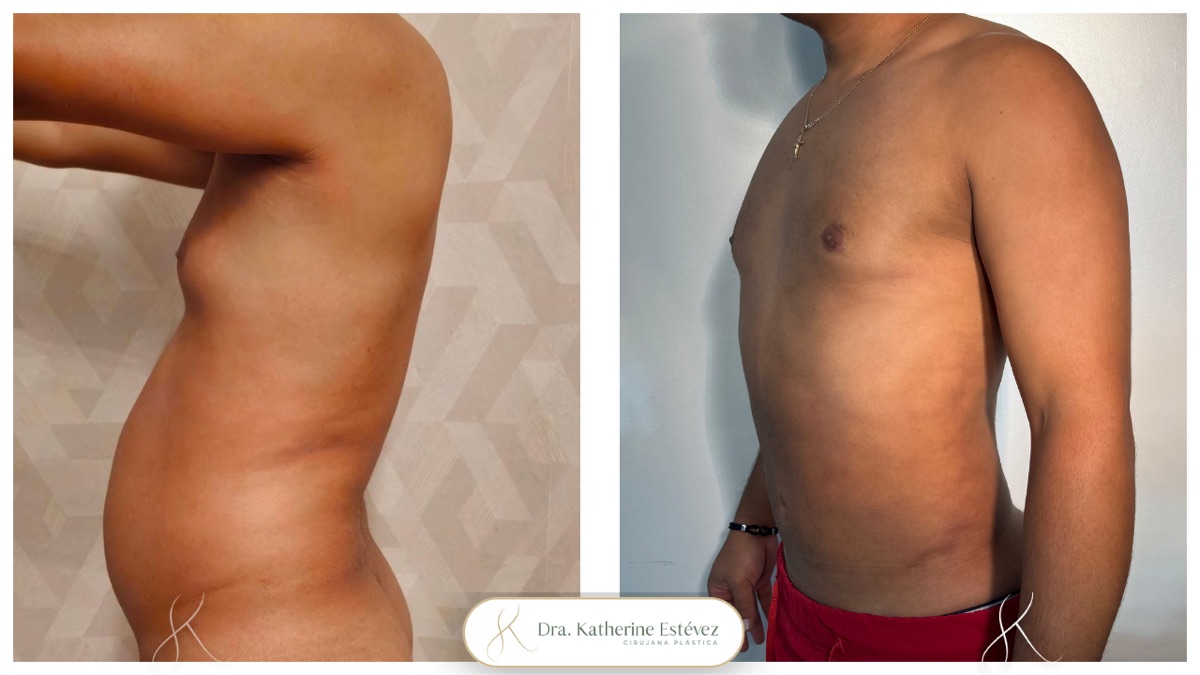 Lipo HD