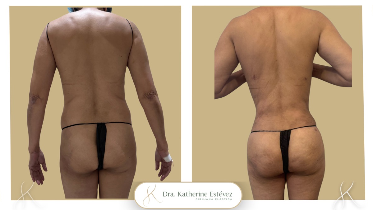 Lipoescultura