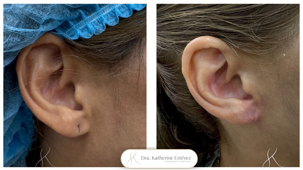Resultado lobuloplastia