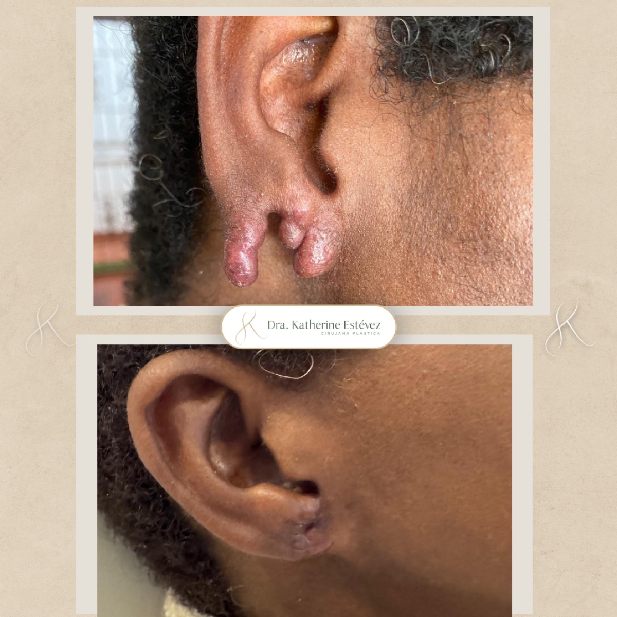 Resultado lobuloplastia 2