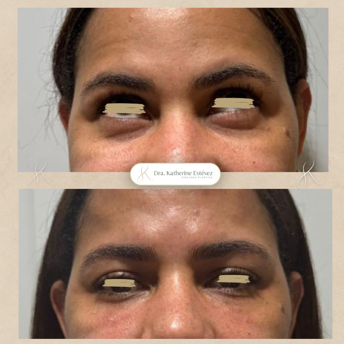 Relleno de Ojeras