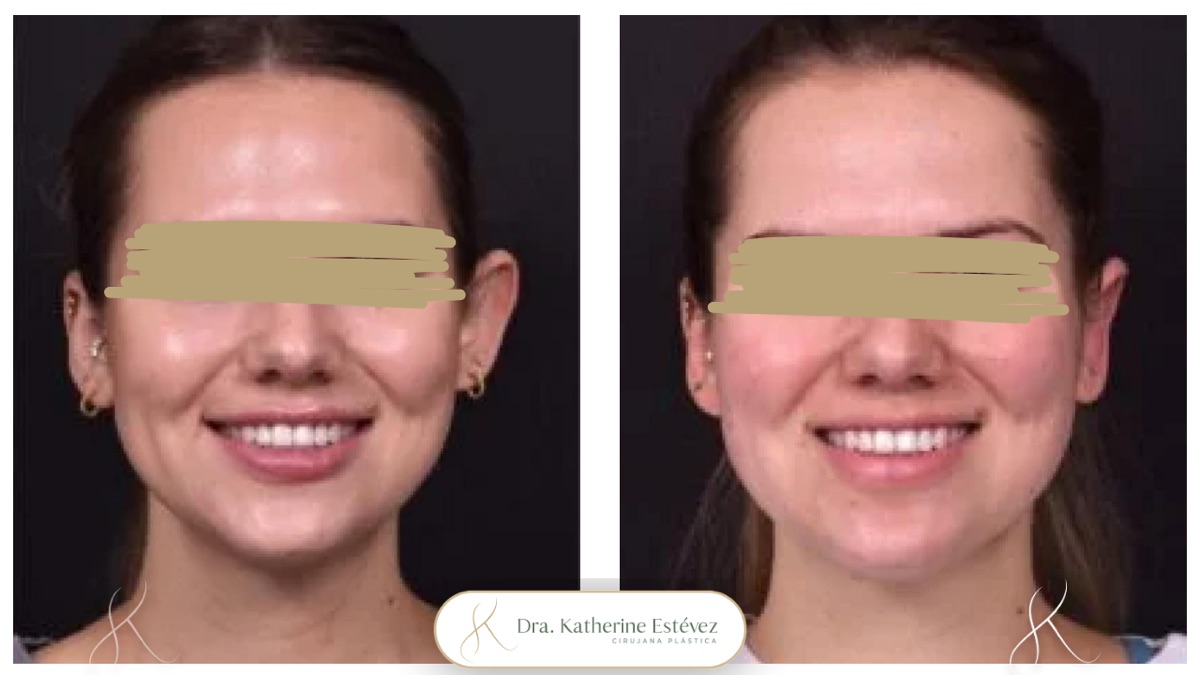 Resultado otoplastia