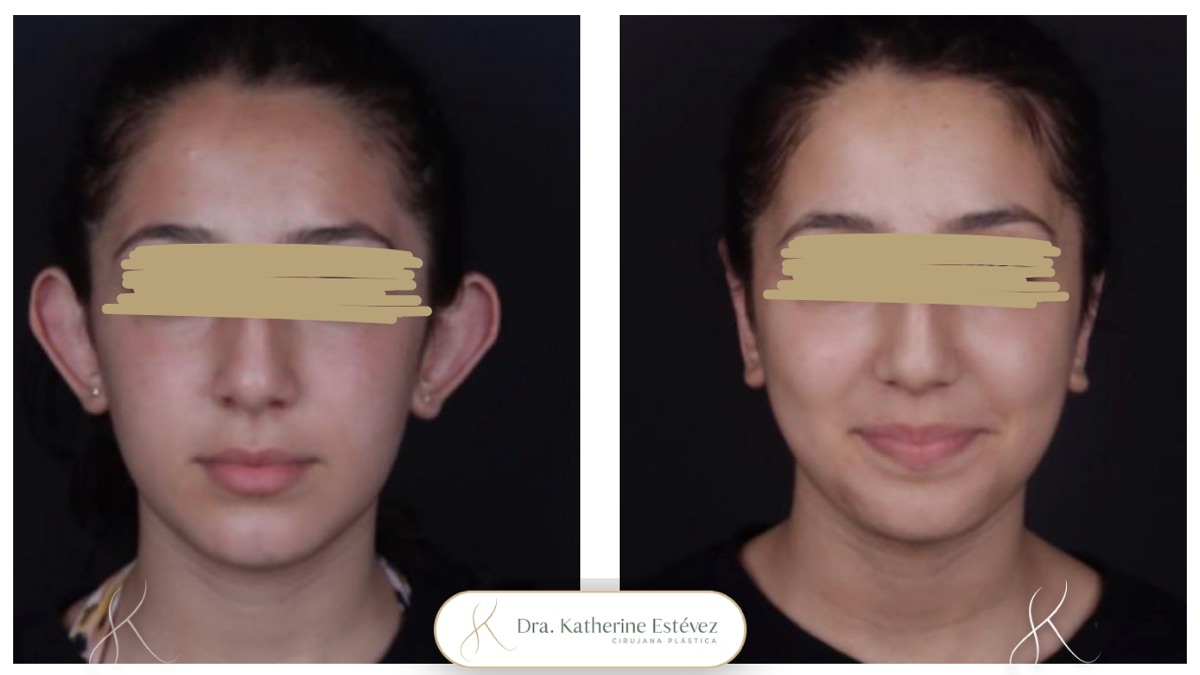 Otoplastia 2