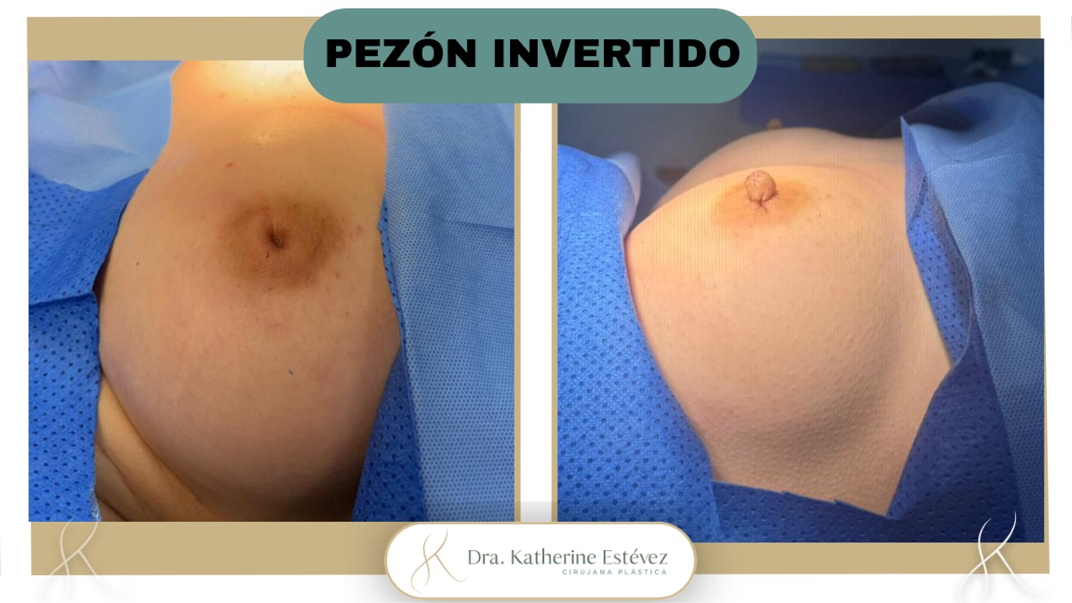 Pezón Invertido