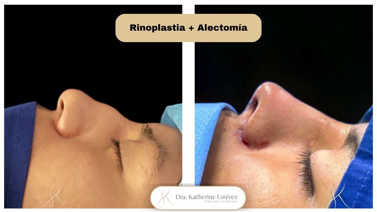 Resultado rinoplastia