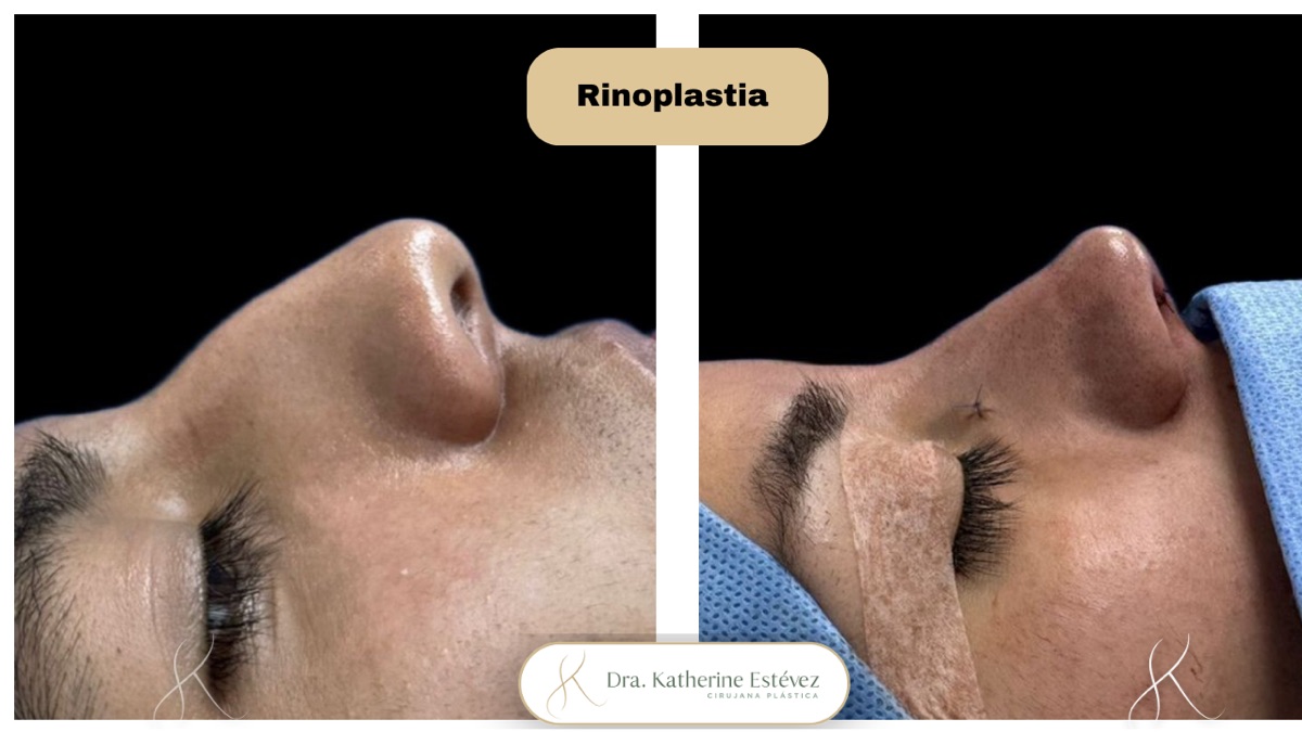 Resultado rinoplastia 2