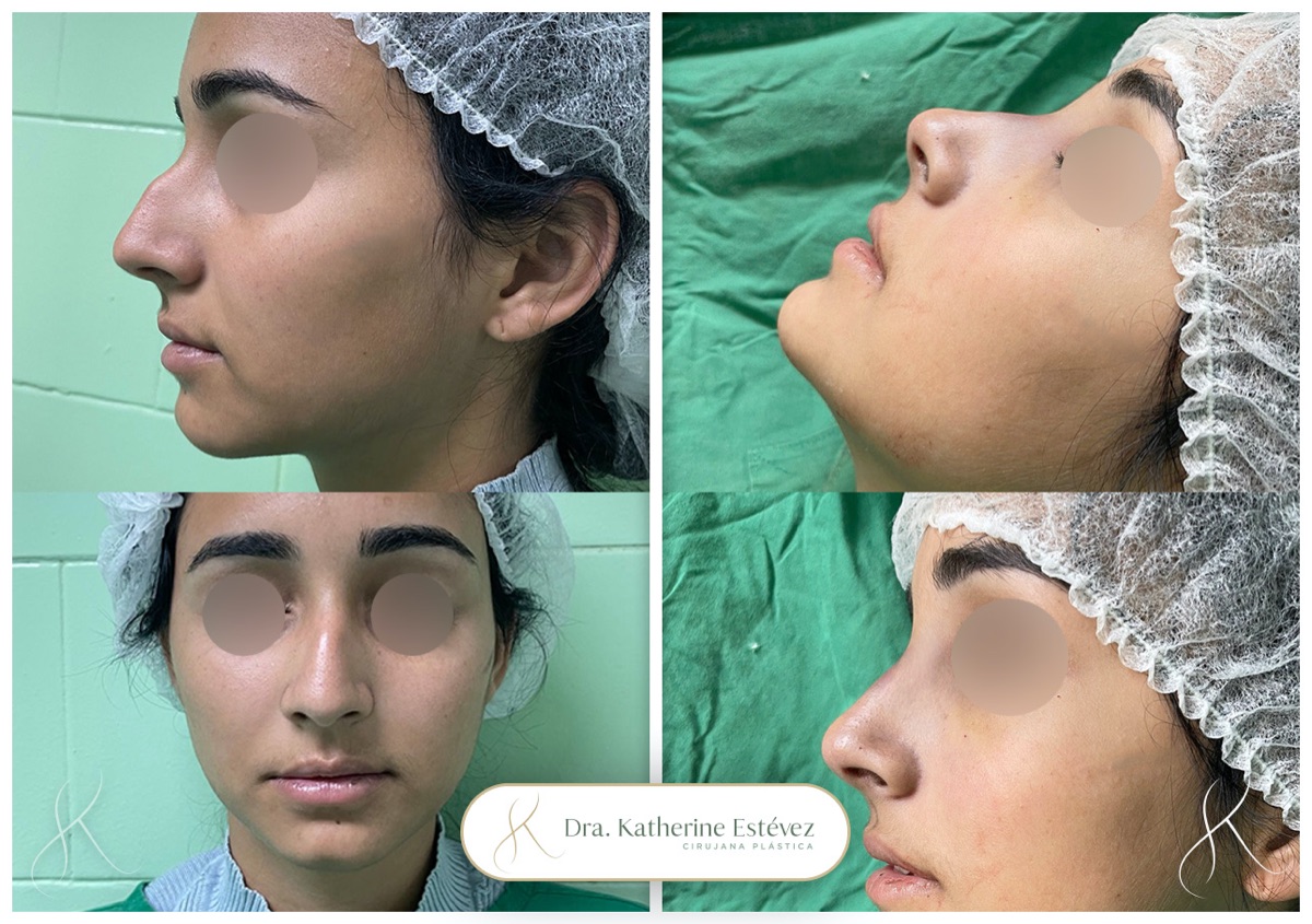 Rinoplastia 3