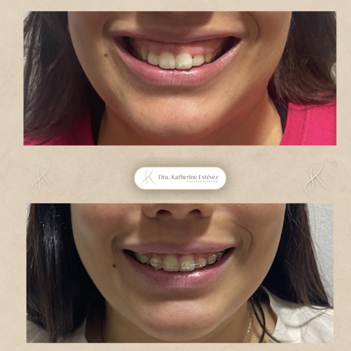 Sonrisa Gingival