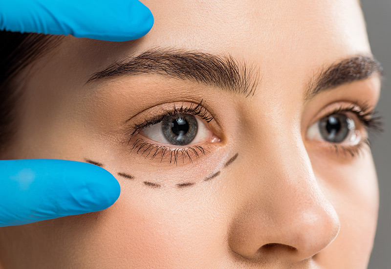 Blefaroplastia · Cirugía de párpados