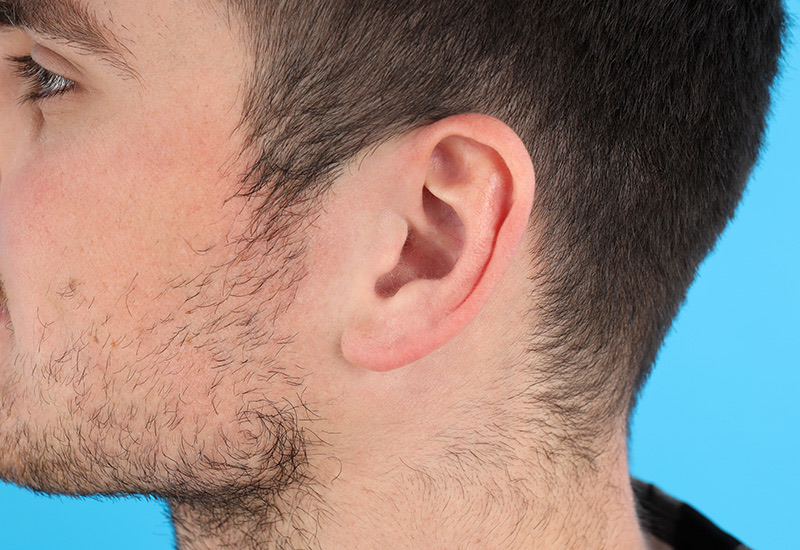 Otoplastia en Hombres