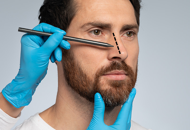 Rinoplastia en Hombres