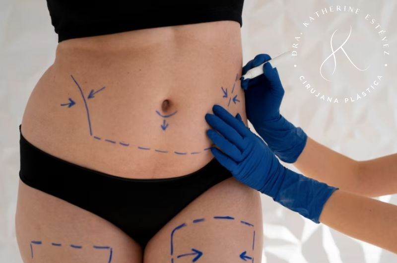 lipoescultura Dra Katherine Estévez