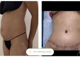 abdominoplastia Dra Katherine Estévez
