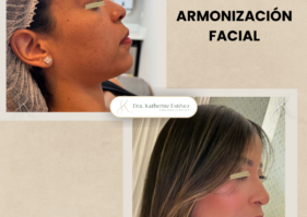 Armonización Facial Dra Katherine-Estévez