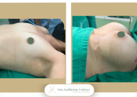 Aumento mamas con implantes Dra Katherine Estevez (2)