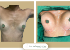 Aumento mamas con implantes Dra Katherine Estevez (1)