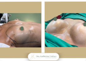 Aumento mamas con implantes Dra Katherine Estevez