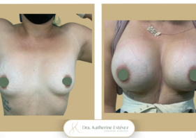 Aumento mamas con implantes Dra Katherine Estevez (3)