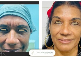 Blefaroplastia y rejuvenecimiento con nano fat Dra katherine Estevez
