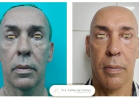 Blefaroplastia y rejuvenecimiento con nano fat Dra katherine Estevez