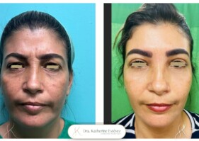 Blefaroplastia y rejuvenecimiento con nano fat Dra katherine Estevez