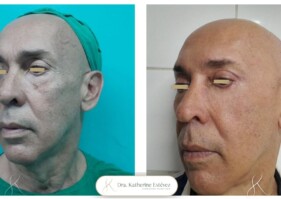 Blefaroplastia y rejuvenecimiento con nano fat Dra katherine Estevez
