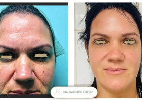 Blefaroplastia y rejuvenecimiento con nano fat Dra katherine Estevez