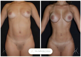 lipoescultura HD con Implantes mamarios lipoescultura HD con Implantes mamarios