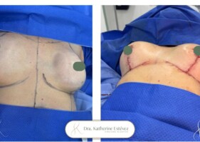 Cambios de implante - mastopexia con implantes Cambios de implante - mastopexia con implantes