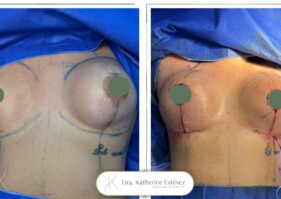 Cambios de implante - mastopexia con implantes Cambios de implante - mastopexia con implantes