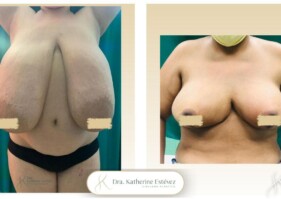 Gigantonastia procedimiento mastoplastia Reductora Gigantonastia procedimiento mastoplastia Reductora
