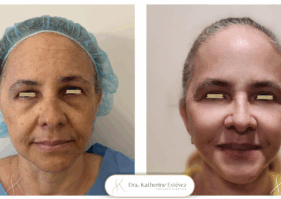 Lifting Facial Dra Katherine Estévez