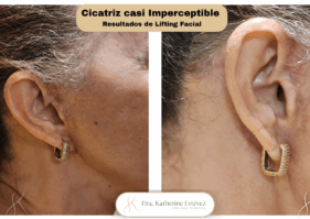 cicatriz Lifting facial Dra Katherine Estévez