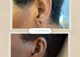 Lobuloplastia Dra Katherine Estévez